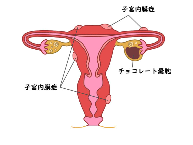 子宮内膜症・子宮腺筋症 - LOG 原宿 産婦人科